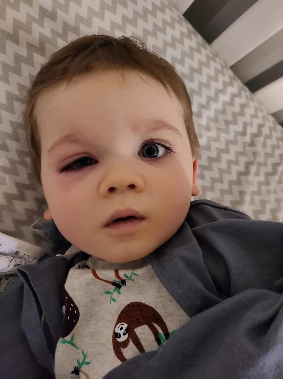The writer's son, with the eye infection that sent him to the hospital. (Photo courtesy Eden Strong)