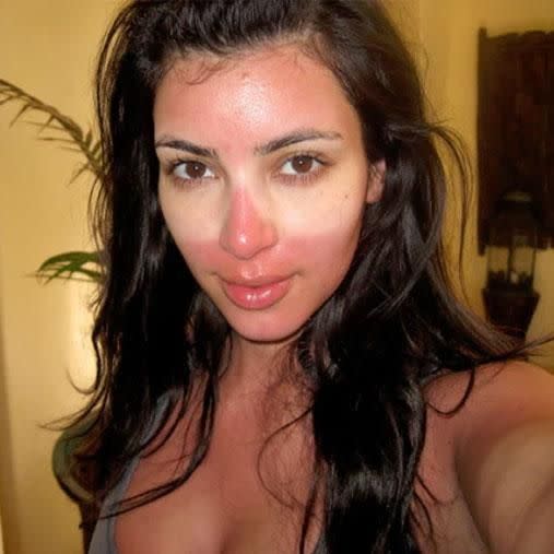 Kim Kardashian definitely learned a lesson about sunscreen after suffering some serious burn. Photo: Twitter/Kim Kardashian West