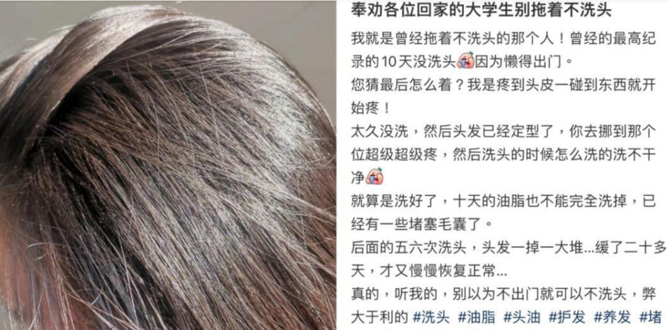 女大生表示，10天不洗頭的下場是毛囊阻塞、頭皮發炎，頭髮狂掉，一碰到頭皮就刺痛不已。（圖／翻攝自小紅書／請叫我毛會長）