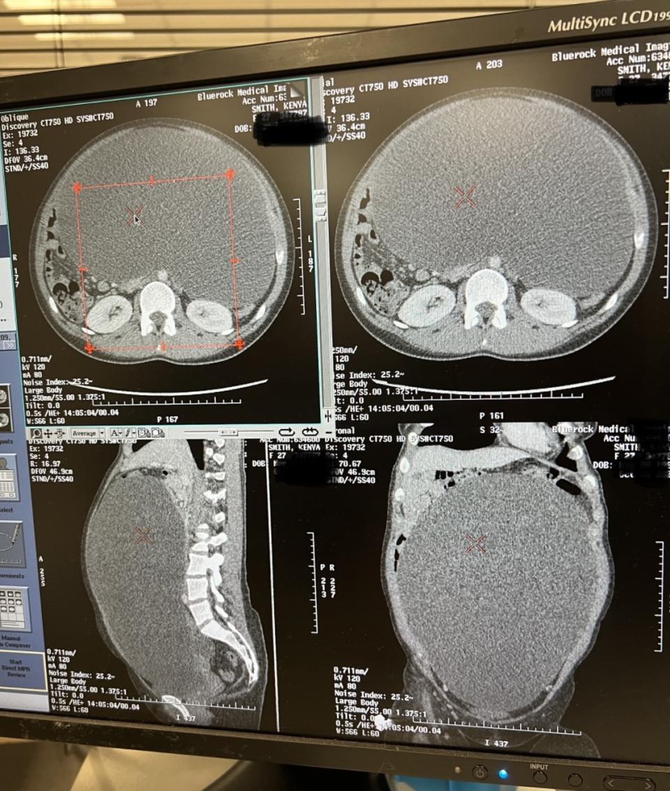 Kenya Smith's CT scan showing an ovarian cyst. 