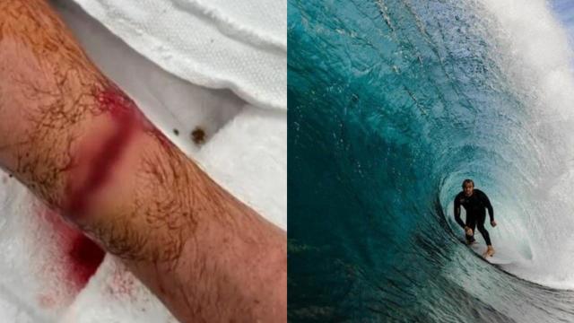 The 30-year-old had to have multiple shark teeth removed from his arm. Picture: Supplied