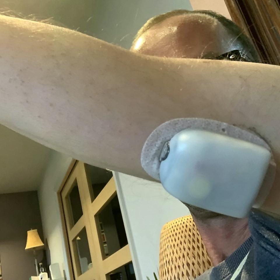 Mr McNairney wearing his Omnipod insulin pump, which he began using in July 2021 - Digby Brown LLP / SWNS