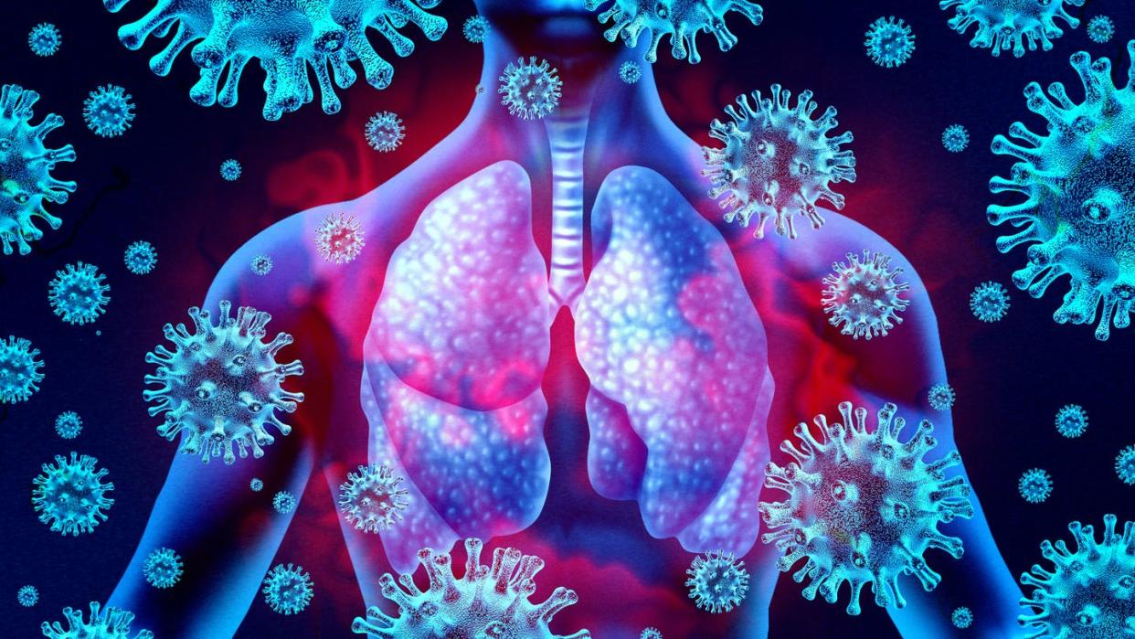 The immune system usually stays dormant in the lungs in times of health. <a href="https://www.gettyimages.com/detail/photo/lung-virus-infection-royalty-free-image/1205199983" rel="nofollow noopener" target="_blank" data-ylk="slk:wildpixel/iStock via Getty Images;elm:context_link;itc:0;sec:content-canvas" class="link ">wildpixel/iStock via Getty Images</a>