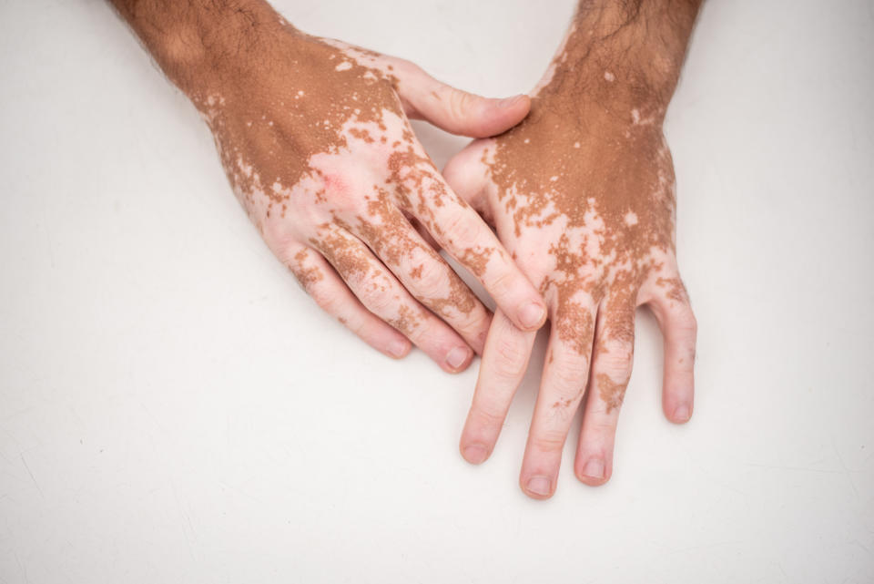 So sieht Vitiligo beim Menschen aus (Symbolbild: Getty)