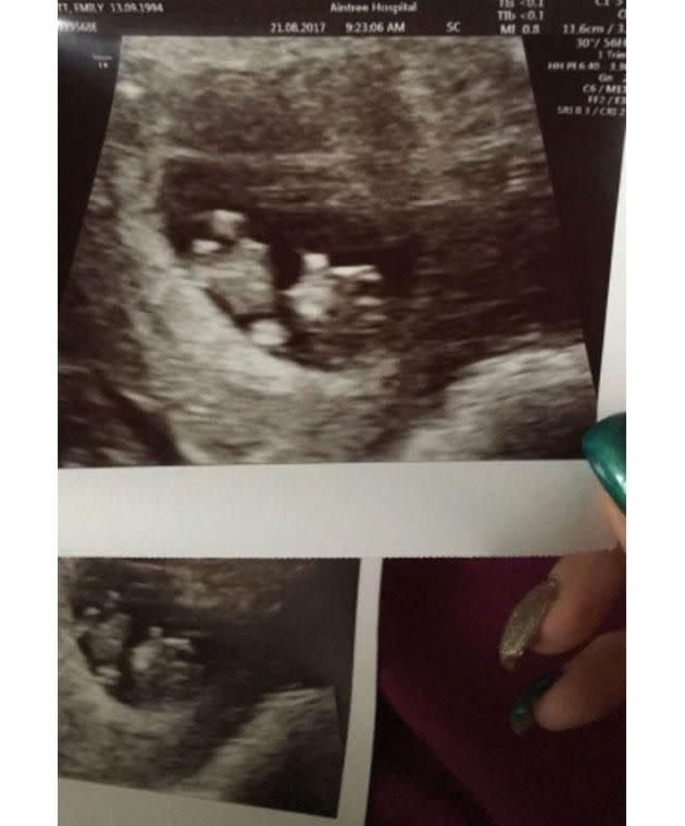 Beckett says she was shocked by what she saw in her ultrasound images. (Photo: Emily Beckett)