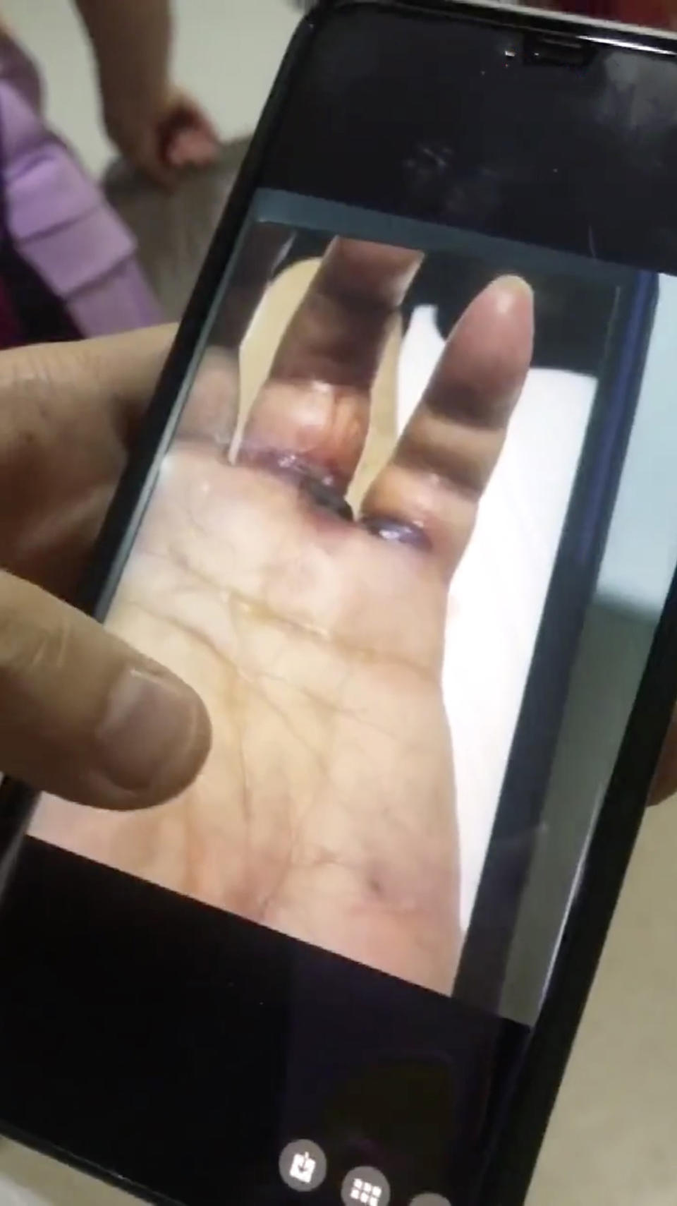 Picture shows the infection beginning to grow on Mr Wang's hand. Source: AsiaWire/Australscope