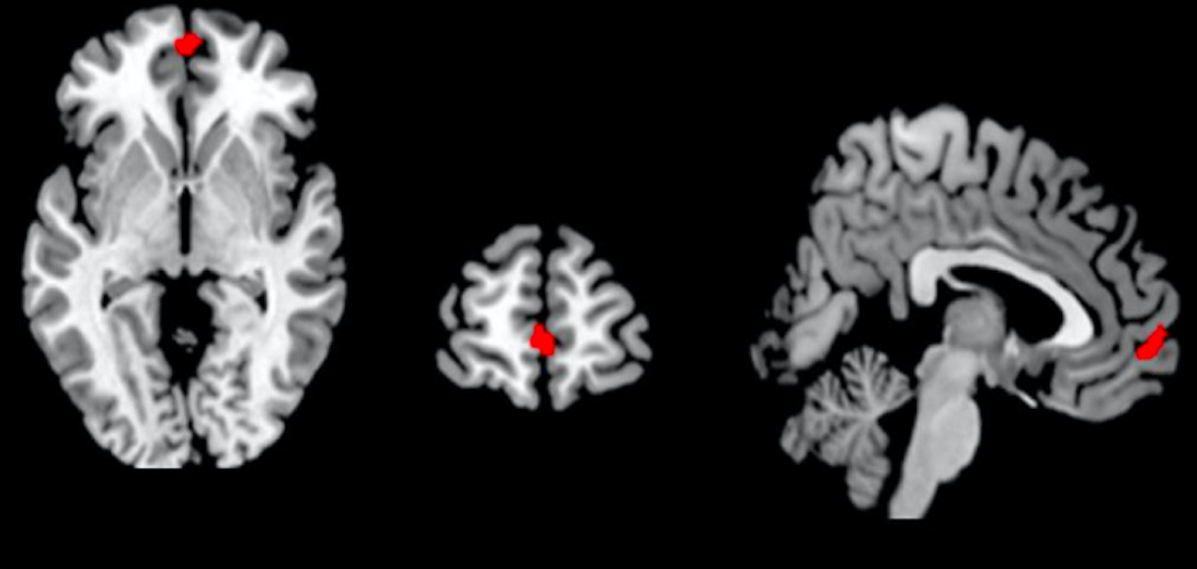 Muestras cerebrales de la voluntad de morir por valores sagrados. Imagen de resonancia magnética a un joven extremista. Captura de pantalla de Neuroimaging ‘will to fight’ for sacred values: an empirical case study with supporters of an Al Qaeda associate. Royal Society Open Science.