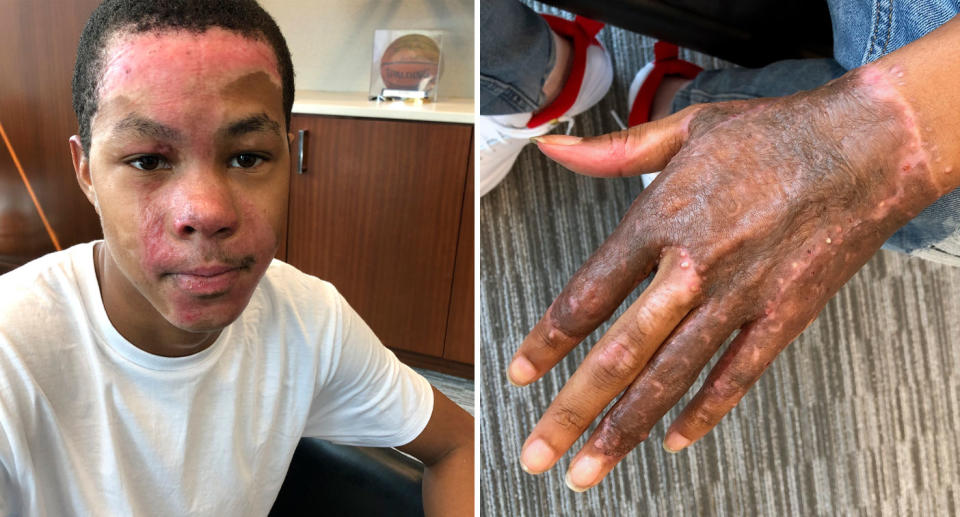 Teen Malachi McFadden pictured with burned face and hand after science teacher's experiment went wrong.