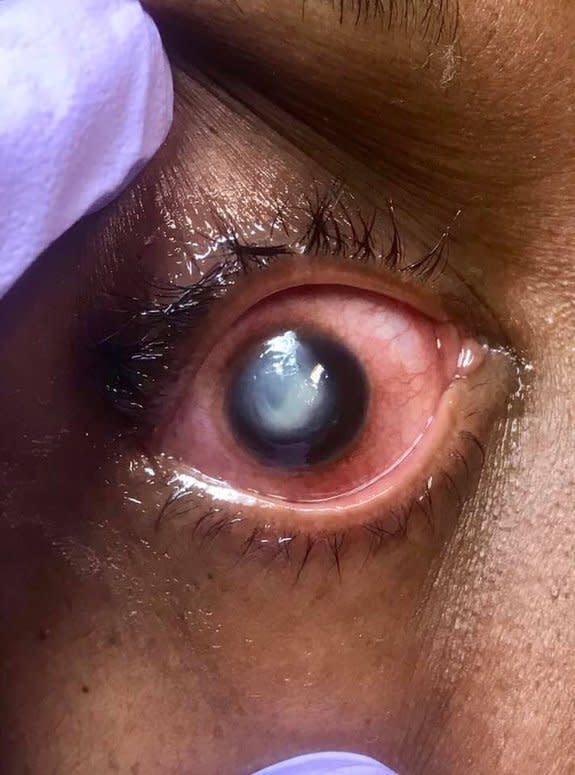 The infected eye before the green dye is added. The dye is used to pool in areas of corneal compromise – in this case, the ulcer bed. (Vita Eye Clinic/ Facebook)