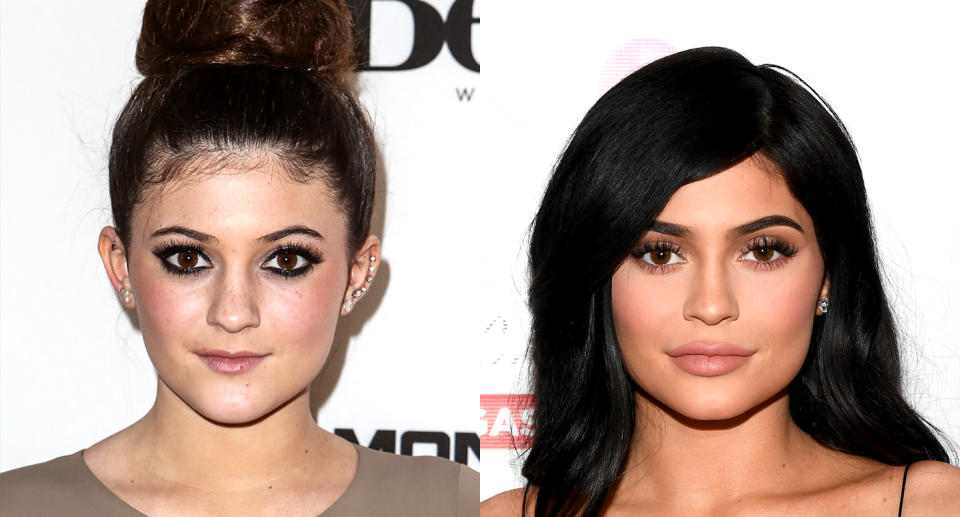 Kylie Jenner shows off her fuller lips. (Photo: Getty Images)