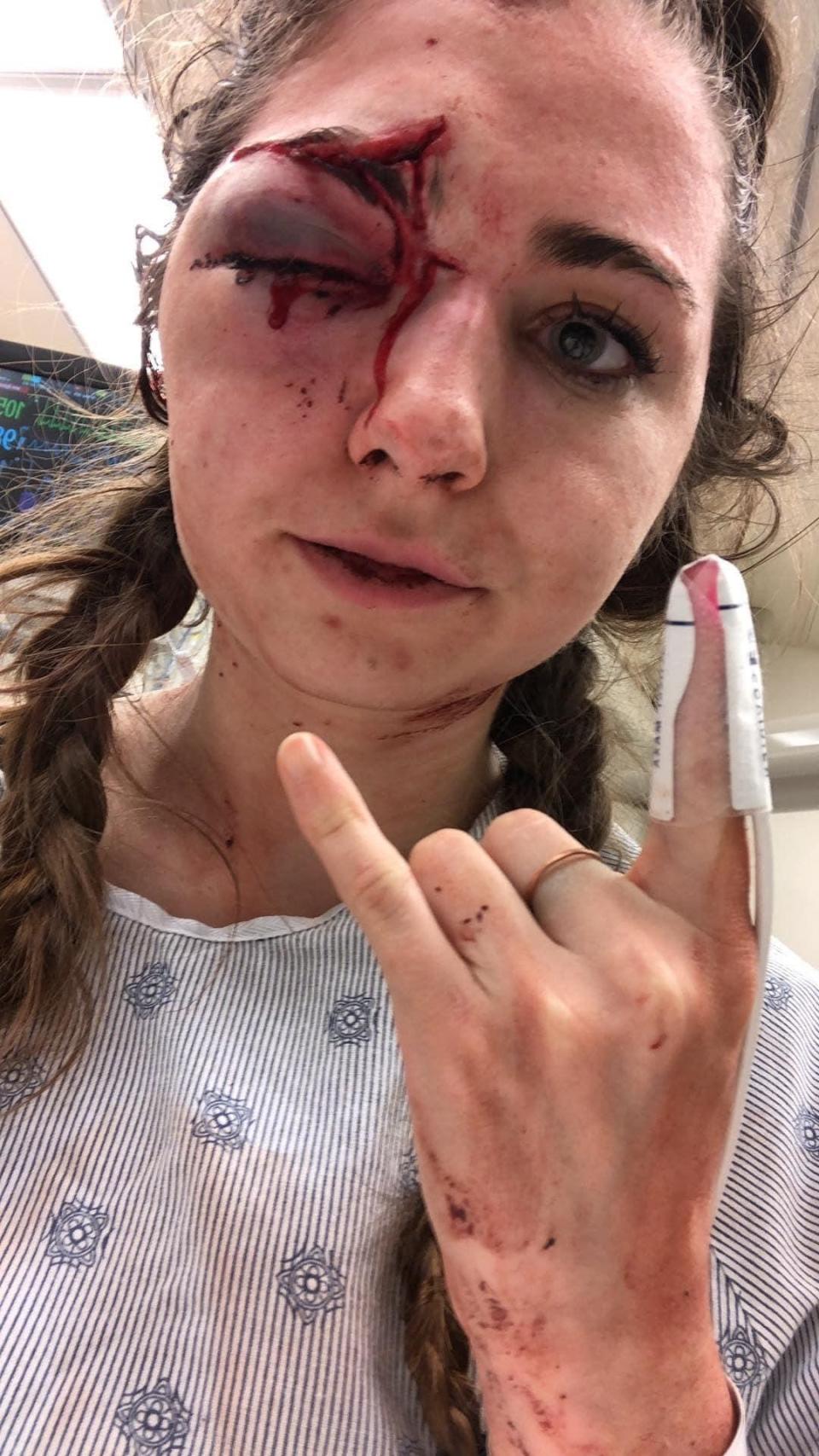 Megan Matthews, 22, in the hospital after she was hit in the eye with a sponge-tipped projectile fired by police at a May 29 protest in Denver.