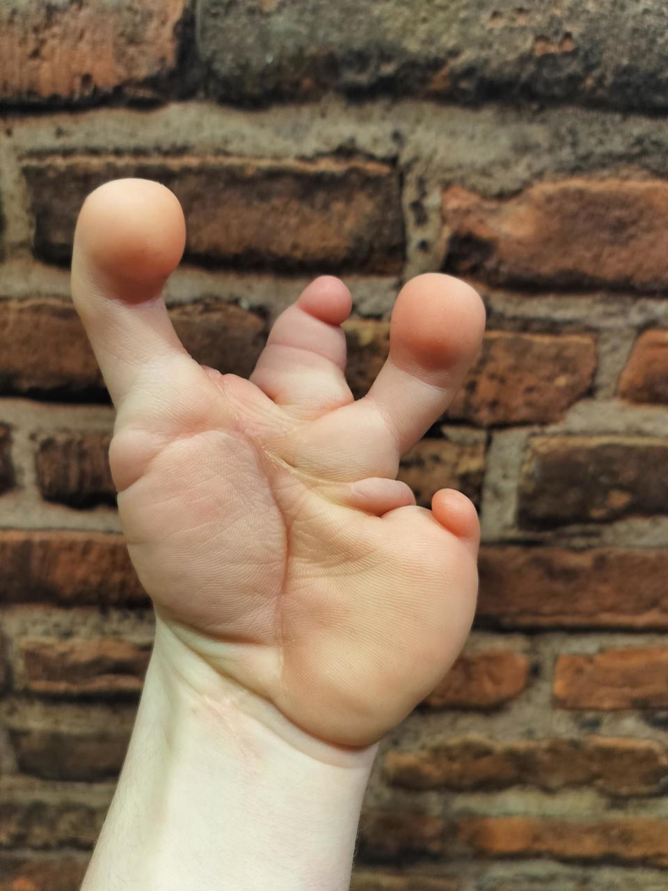 A person's hand with double thumb mutation