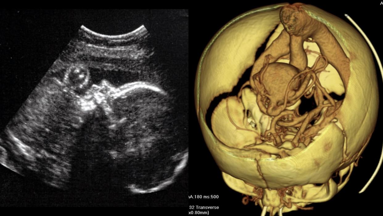  Two images shown side by side. Left image shows an Ultrasound of a healthy baby in-utero. Right image shows a 3D diagram of blood vessels in a human baby's brain, showing a malformation known as the a "vein of Galen malformation" 