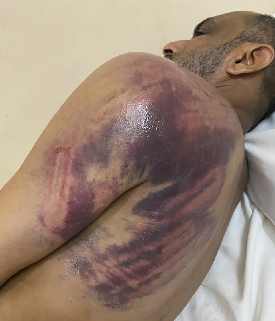 This photo shows Ismail Jussa, an official with Tanzania's opposition ACT Wazalendo party, after what the party alleges was a severe beating by soldiers on election day on Wednesday, Oct. 28, 2020, in Zanzibar. Vote-counting was far from over when Tanzanian opposition leader Seif Sharif Hamad was frustrated enough to call people onto the streets. As thwarted observers alleged the most blatant election fraud in the country’s history, and with no way to challenge the results in court, there was little to do but protest. (AP Photo)