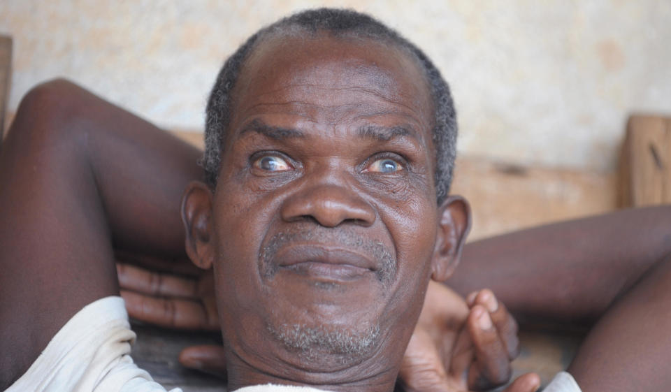 A blind man suffering from river blindness, caused by a parasitic worm, spread by the bite of an infected blackfly, in the Ivorian town of Kouadioa-Allaikro, 2008. Most infected persons are in Africa, and the disease is found most frequently in rural agricultural villages that are located near rapidly flowing streams. (Photo: ISSOUF SANOGO/AFP/Getty Images)