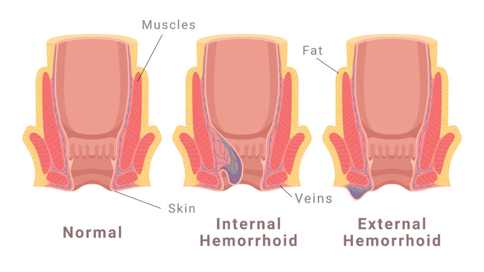 an illustration of of internal and external hemorrhoids, which do itch