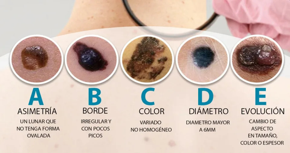 El ABCDE para localizar un posible melanoma | SkinMed