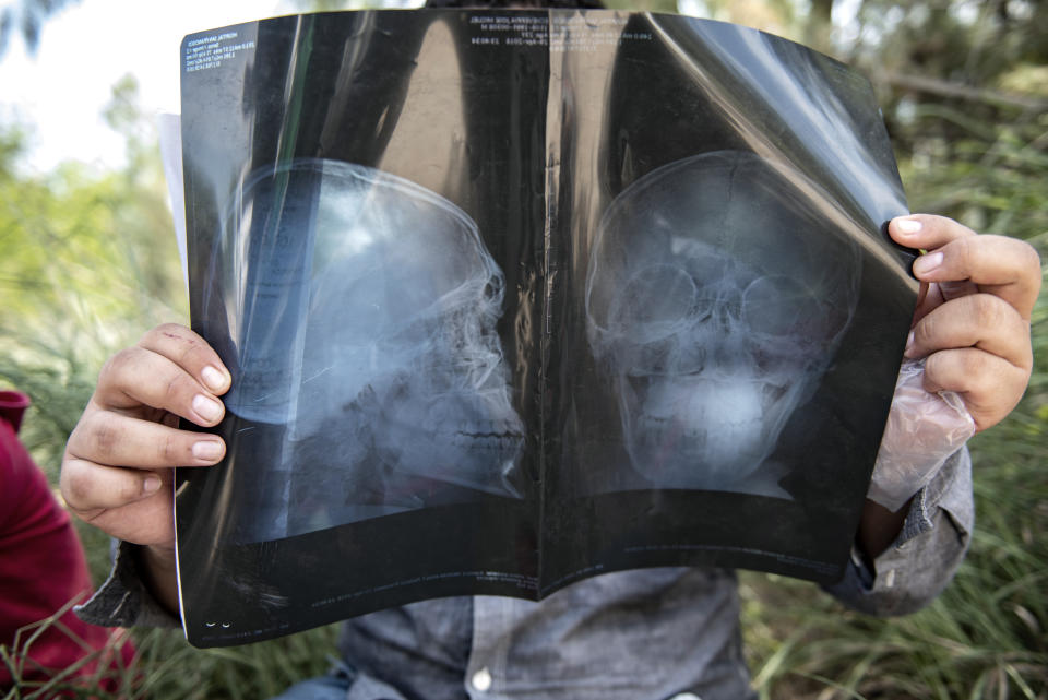 An illegal immigrant holds his x-ray while being detained south of McAllen, Texas on Tuesday, June 5, 2018. The man had suffered a head injury leaving an indentation on his forehead and came to America seeking a medical treatment. (Photo: Sergio Flores for Yahoo News)