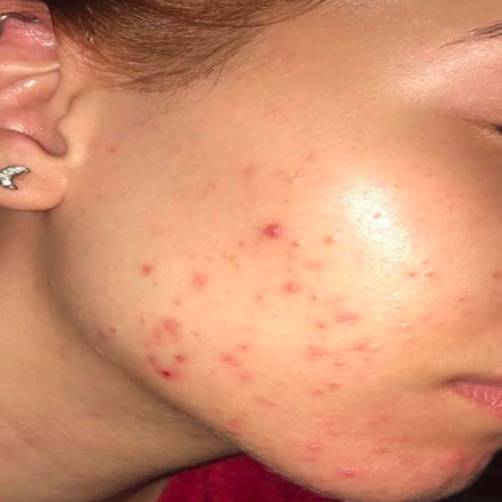 A reviewer photo of someone's skin before using the rosehip oil. The skin appears to have a lot of redness. 