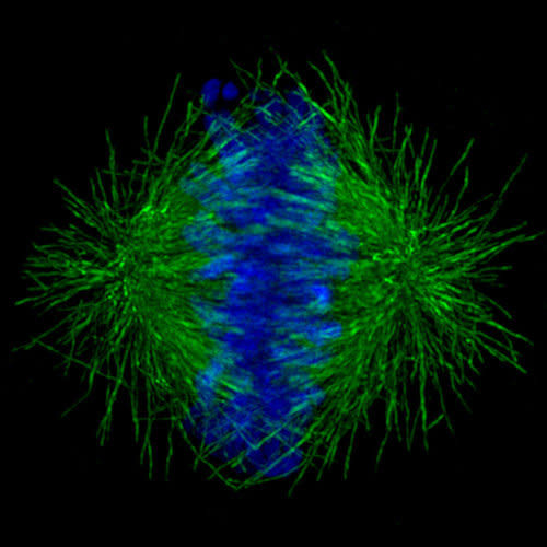 Another cancerous cervical cell during cell division. DNA is in blue.