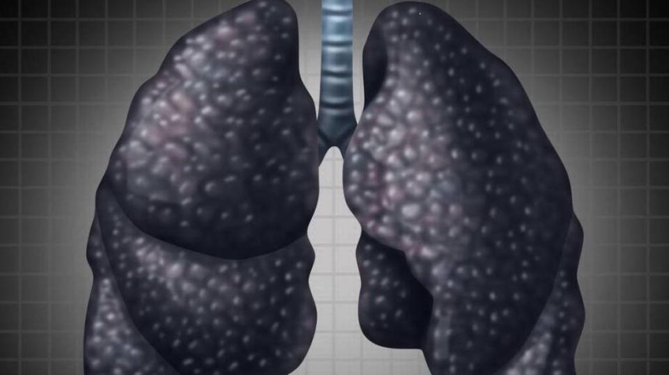 Black-lung disease damages the organ and causes a decline in respiratory function.