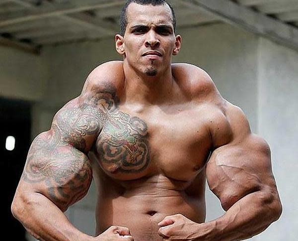 Un estudio publicado por Journal of Medical Case Reports señala que las inyecciones de Synthol pueden poner en riesgo la salud y generar problemas de fibrosis y desfiguración musculares.