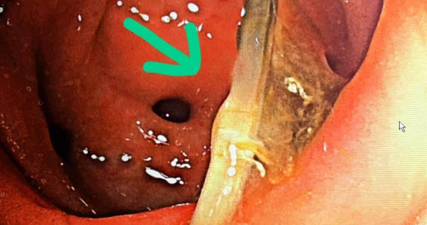 透過大腸鏡檢查才發現是長4公分的魚刺卡在乙狀結腸，尖刺兩端還牢牢地刺在大腸壁上。（圖／聖馬爾定醫院提供）