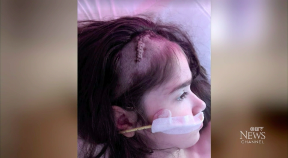 Ellie Tomljanovic, 9, is one of the first patients in a study to see if deep brain stimulation (DBS) can stop children who repeatedly try to hurt themselves (CTV News/video screengrab)