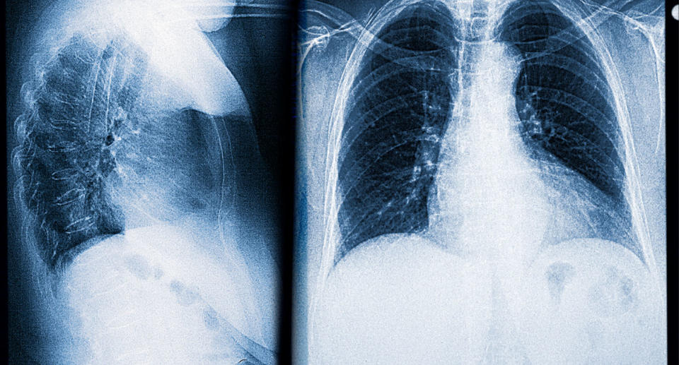 Chest and lung x-ray.