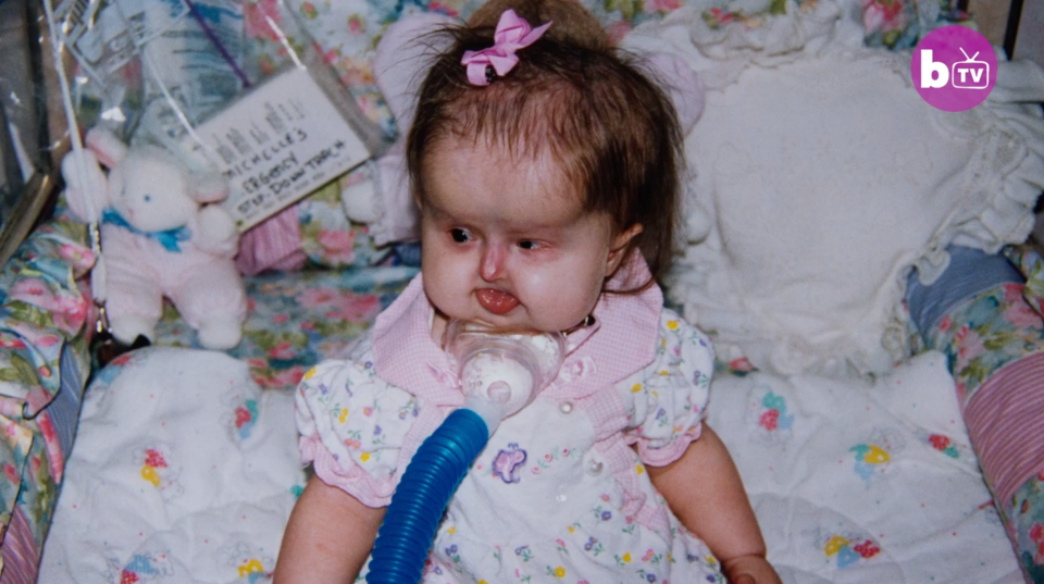 Michelle was diagnosed at birth, with experts called in to help with her rare condition. Photo: Barcroft