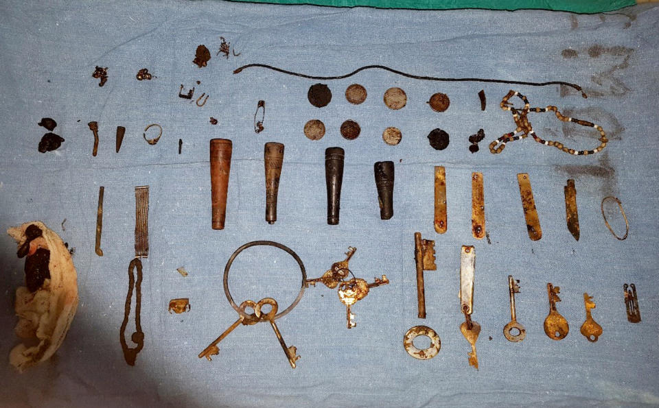 Doctors in the city of Udaipur in the state of Rajasthan, India, were astounded to see over 80 metallic and other foreign objects lodged in the abdomen and intestine of a 24-year-old man. (SWNS)