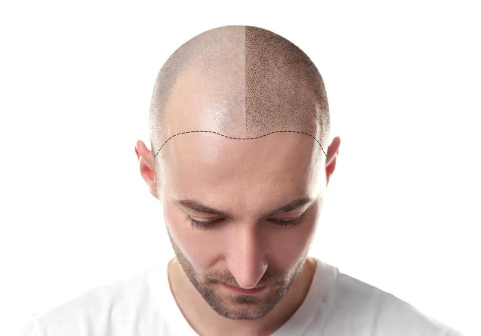 Stressed cells may be to blame for hair loss. Africa Studio – stock.adobe.com