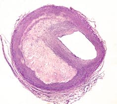 <span class="caption">Cross section of an artery, showing an atheroma (blockage) on the left.</span> <span class="attribution"><a class="link " href="https://www.shutterstock.com/image-photo/cross-section-artery-showing-atheroma-plaque-455301583?src=D_4SzoepwPgwe3djBuff9w-1-6" rel="nofollow noopener" target="_blank" data-ylk="slk:Jose Luis Calvo/Shutterstock;elm:context_link;itc:0;sec:content-canvas">Jose Luis Calvo/Shutterstock</a></span>