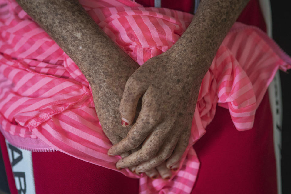 In this Wednesday, July 24, 2019 photo, a girl affected by a rare disorder called xeroderma pigmentosum, or XP, waits for a skin checkup with her family at a hospital in Casablanca, Morocco. The disorder affects about 1 in 10,000 people in North Africa _ more than 10 times the rate in Europe and about 100 times the rate in the United States, according to Dr. Kenneth Kraemer, who researches XP at the U.S. National Institutes of Health. (AP Photo/Mosa'ab Elshamy)