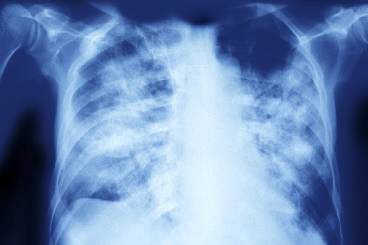 An X-ray image showing pulmonary aspergillosis.  (BSIP / UIG via Getty Images)