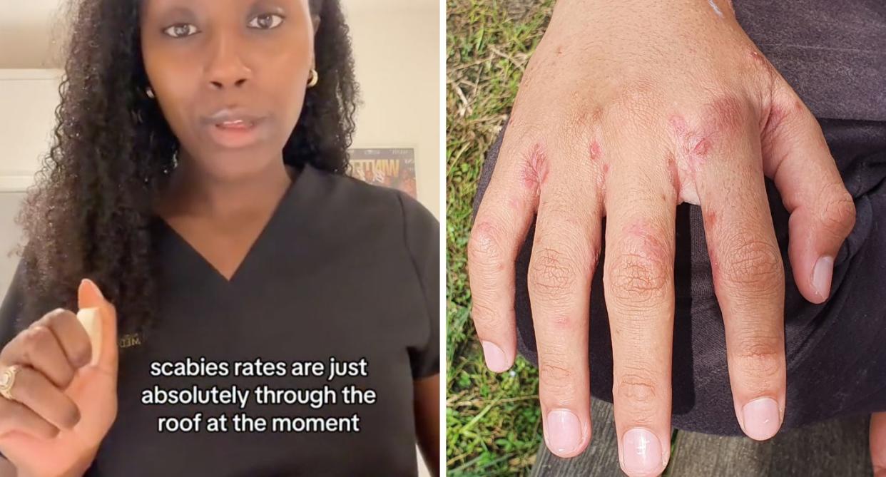 Dr Emma Amoafo-Mensah made a TikTok talking about how she has noticed a lot of persistent cases of scabies are due to patients not using the medicine properly. (Credit: DermDrEmma via TikTok / Getty)