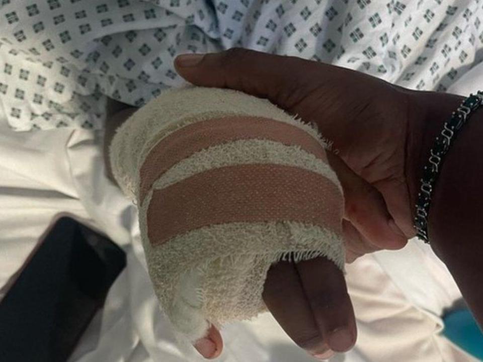 Surgeons failed to save Raheem's finger after a six-hour operation. (Picture: Facebook/Shantal Bailey)