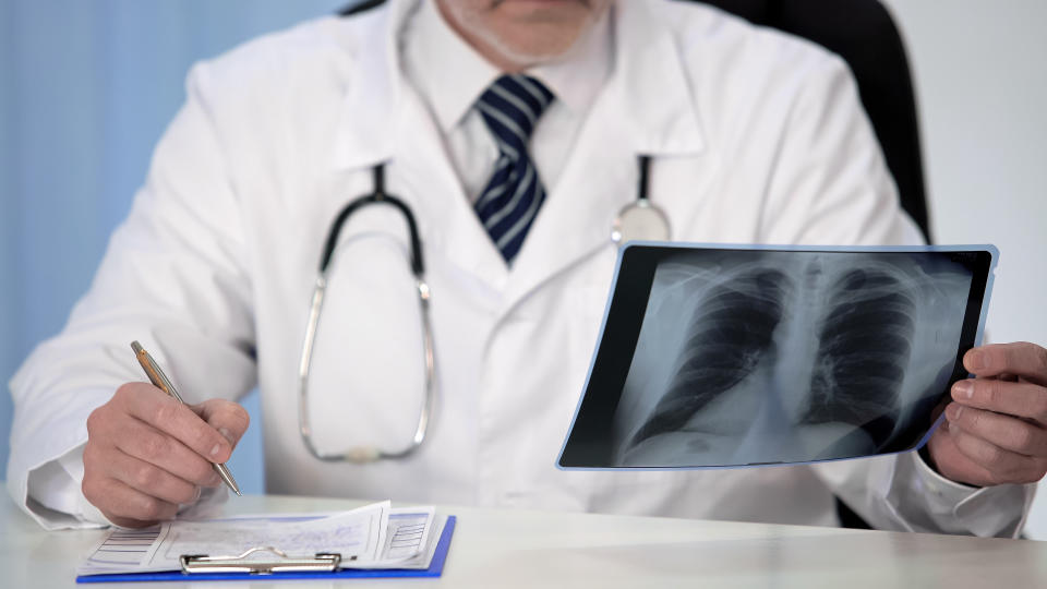 Doctor looking at a lung x-ray