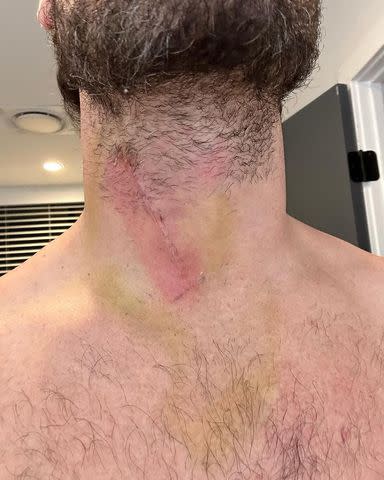 <p>Val Chmerkovskiy/Instagram</p> The 'Dancing with the Stars' pro also posted a photo of his bruised neck