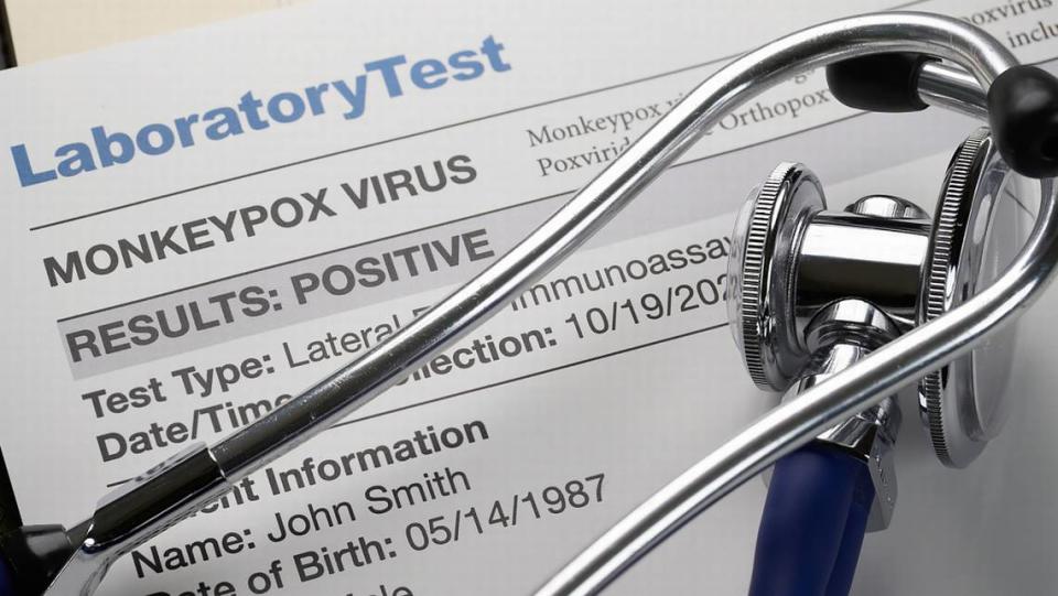 Monkeypox virus test results document with stethoscope