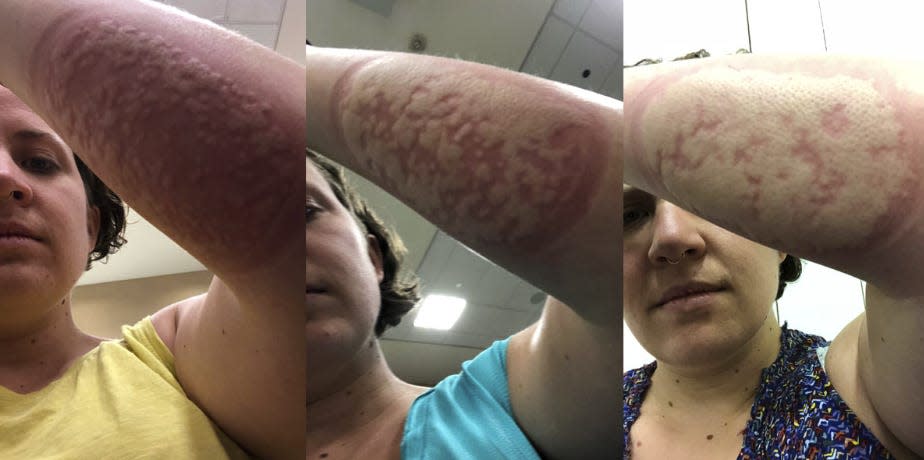 three side by side photos of carolina's arm, covered in bites