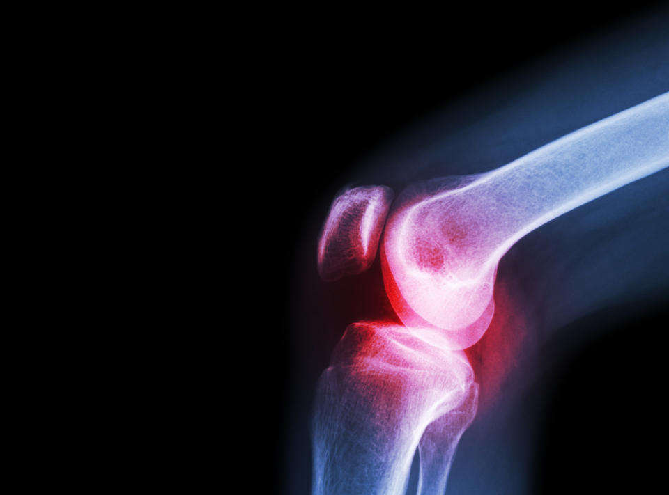 Wer bei Geräuschen oder Schmerzen im Knie sichergehen will, sollte seine Beschwerden vom Arzt abklären lassen – möglicherweise entwickelt sich eine Arthrose. (Bild: Getty Images)