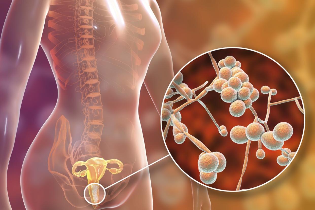 candida albicans infection in female, illustration