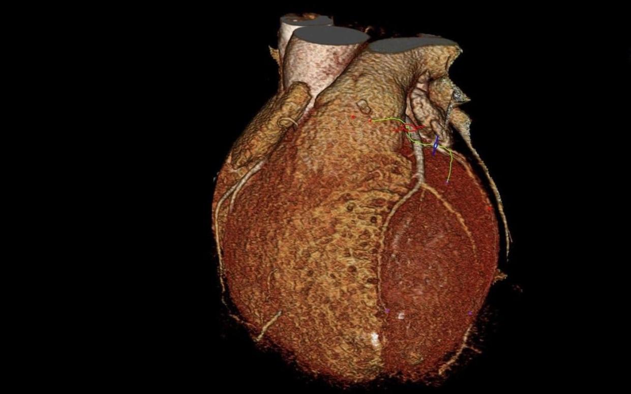  Illustration of heart made using CT scans -  Rebecca Flude