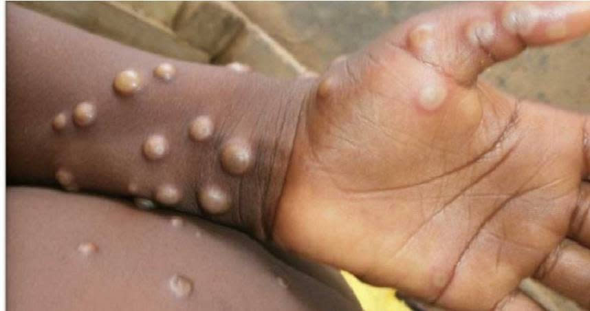 疾病管制署今（5）日公布國內首例兒童猴痘（Mpox）確定病例，是北部一位4歲男童。（圖／翻攝自美國CDC官網）