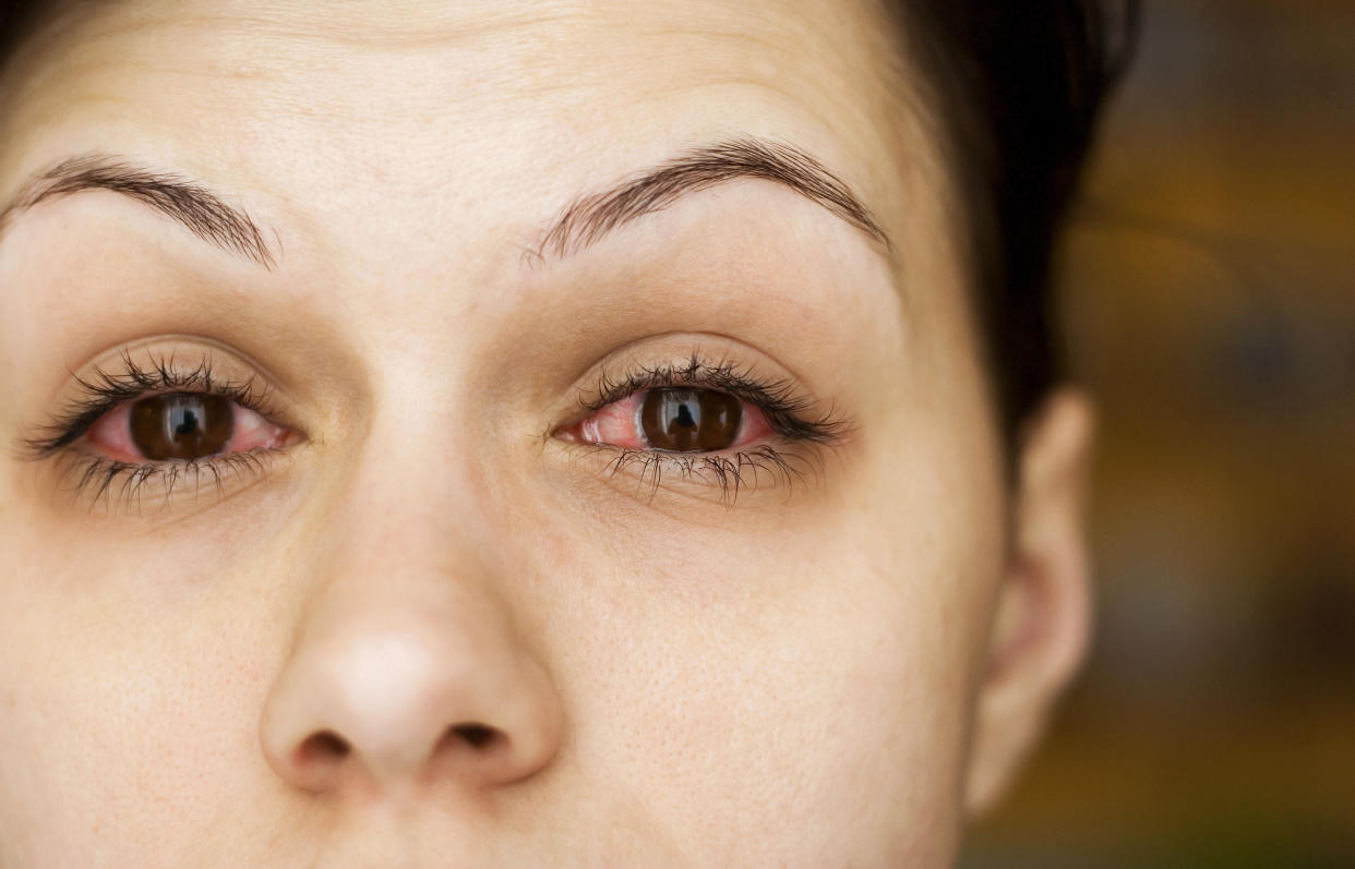 A new research letter suggests patients with COVID-19 are getting pink eye that lasts for weeks. Experts unpack what that means. 