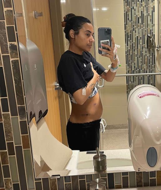 PHOTO: Raquel Rodriguez, of Minnesota, is pictured the day before having a 10-pound cyst removed from her stomach. (Courtesy Raquel Rodriguez)