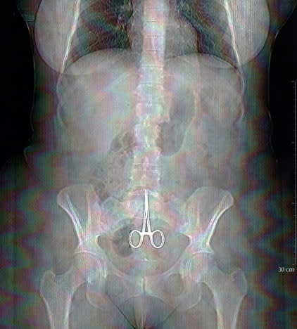 A x-ray made on February 13, 2011 in Lyon, shows a pair of surgical pliers in the abdomen of Anne, a women who complained of abdominal pain after a surgery. Six months after her surgical operation, Anne realized she had a pair of surgical pliers which had been forgotten in her womb, when the point of the pliers pierced her navel following a "good fit of coughing" on last February 11. AFP PHOTO