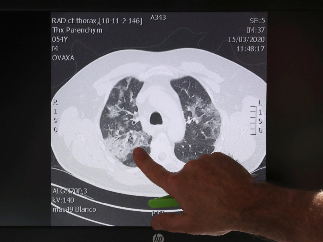 coronavirus covid-19 lung scan