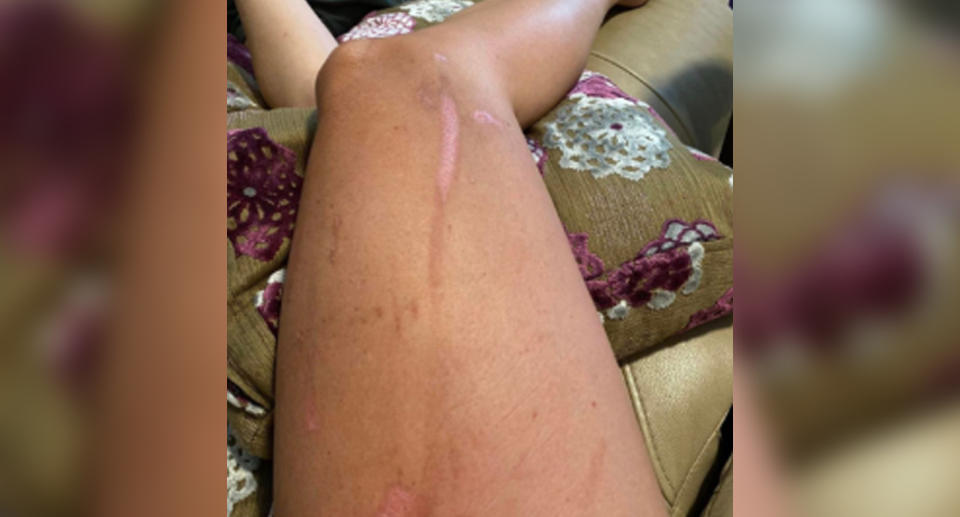 The painful rash from a tomcat beetle in Bali looks like a red stinger mark on her right thigh. 